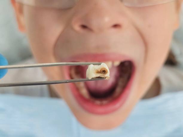 Best Emergency Tooth Extraction in Mulgee, OK